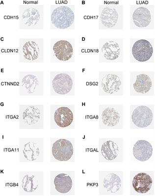 Comprehensive landscape of junctional genes and their association with overall survival of patients with lung adenocarcinoma